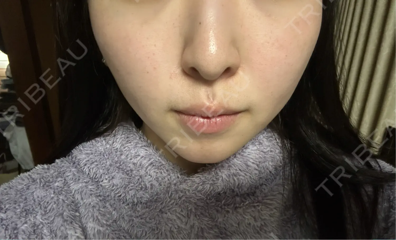 施術後の写真