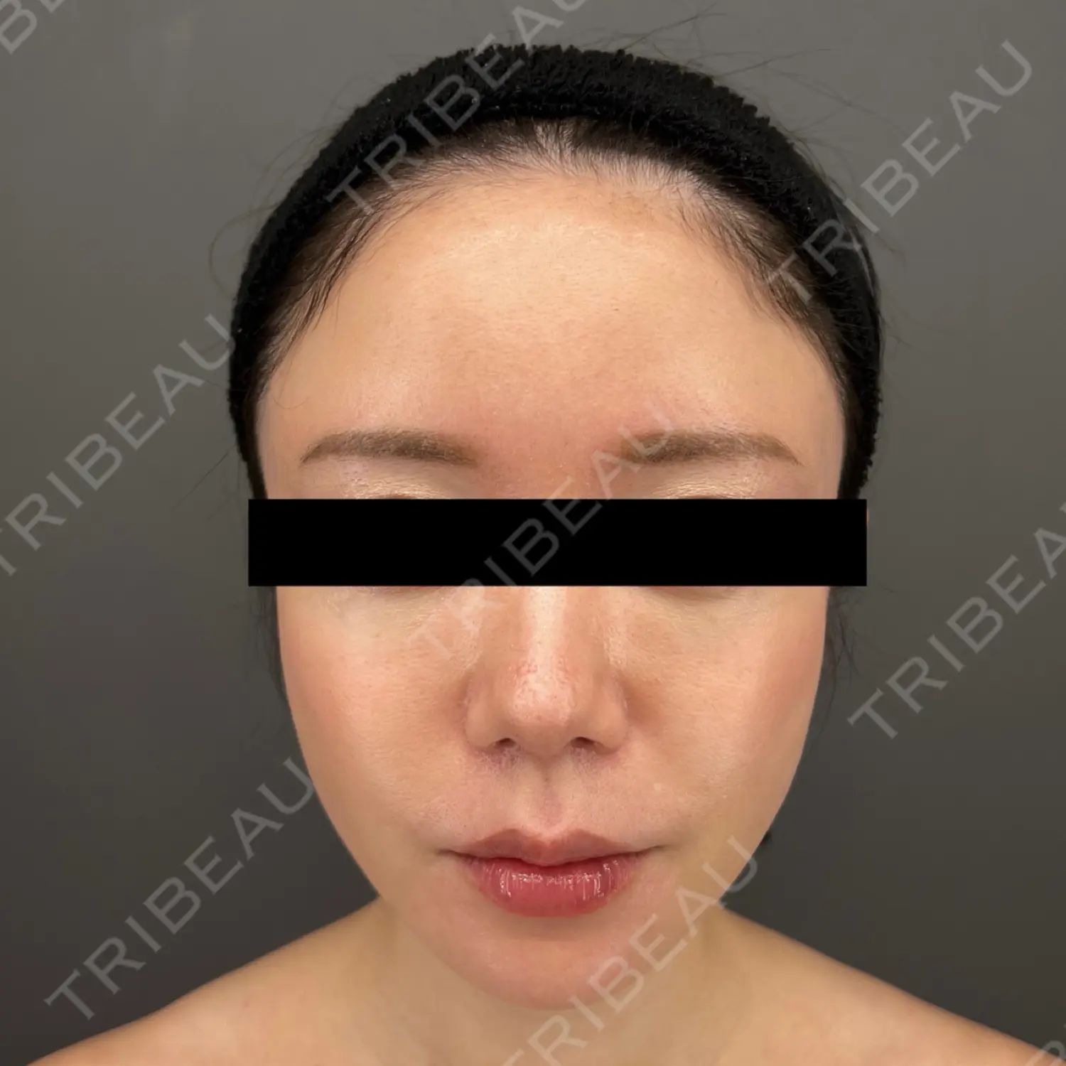 施術後の写真