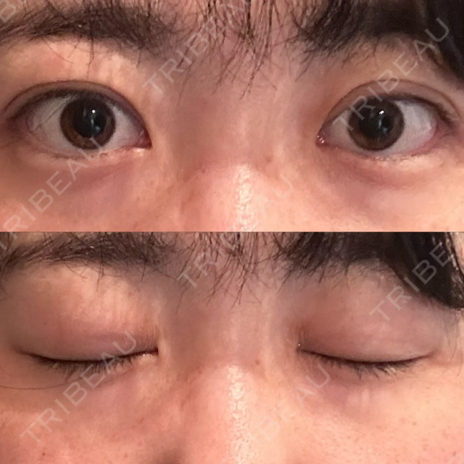 施術後の写真