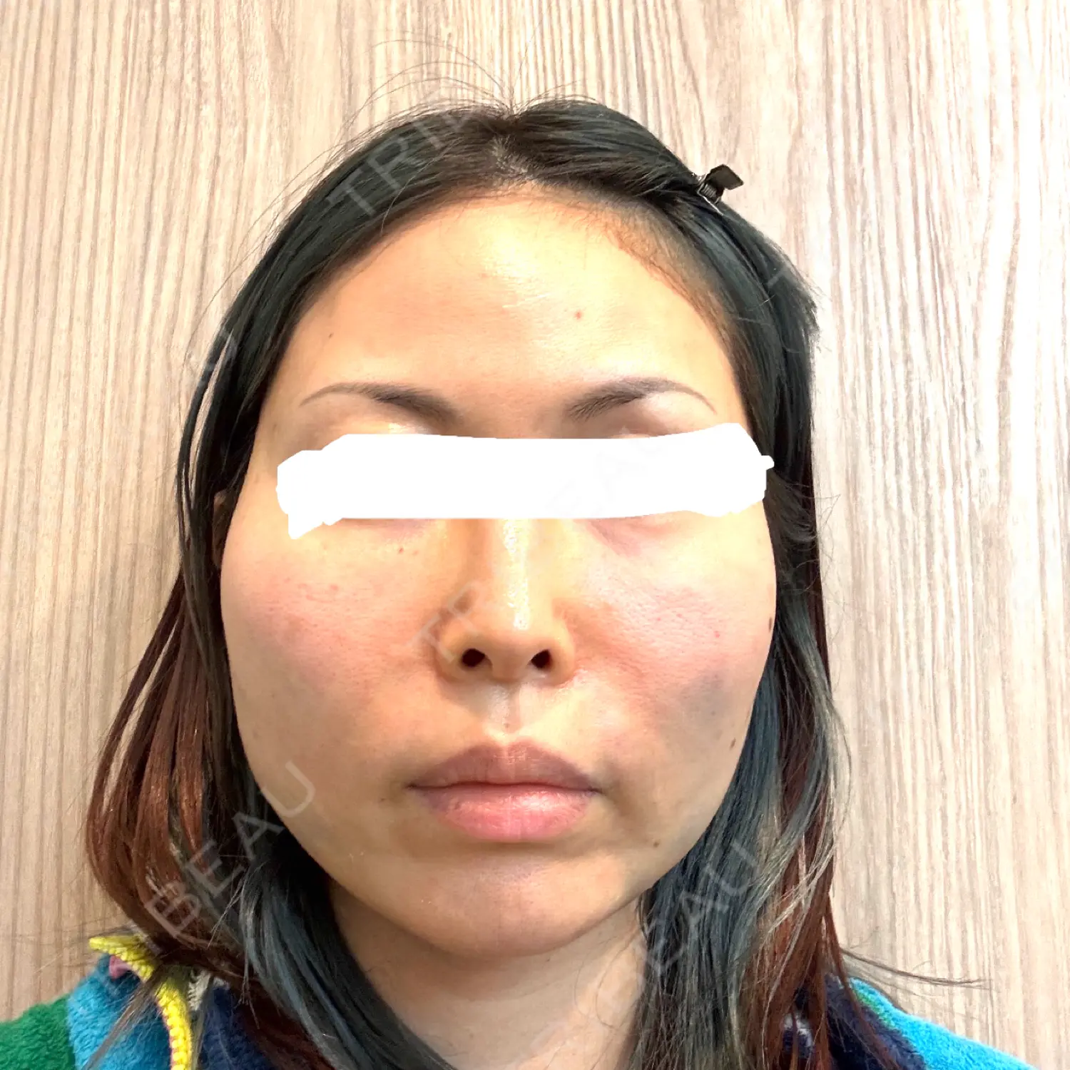 施術後の写真
