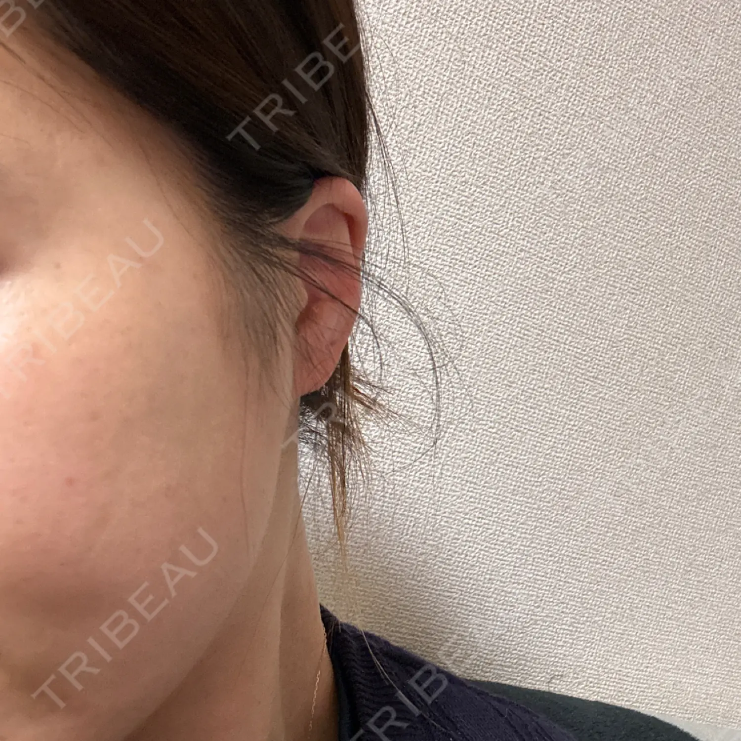 施術後の写真