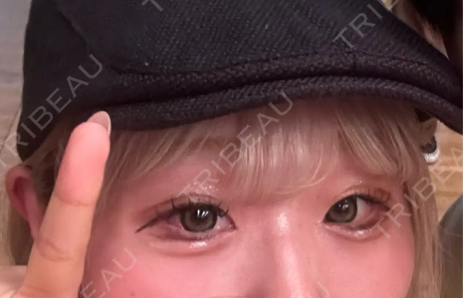 施術後の写真