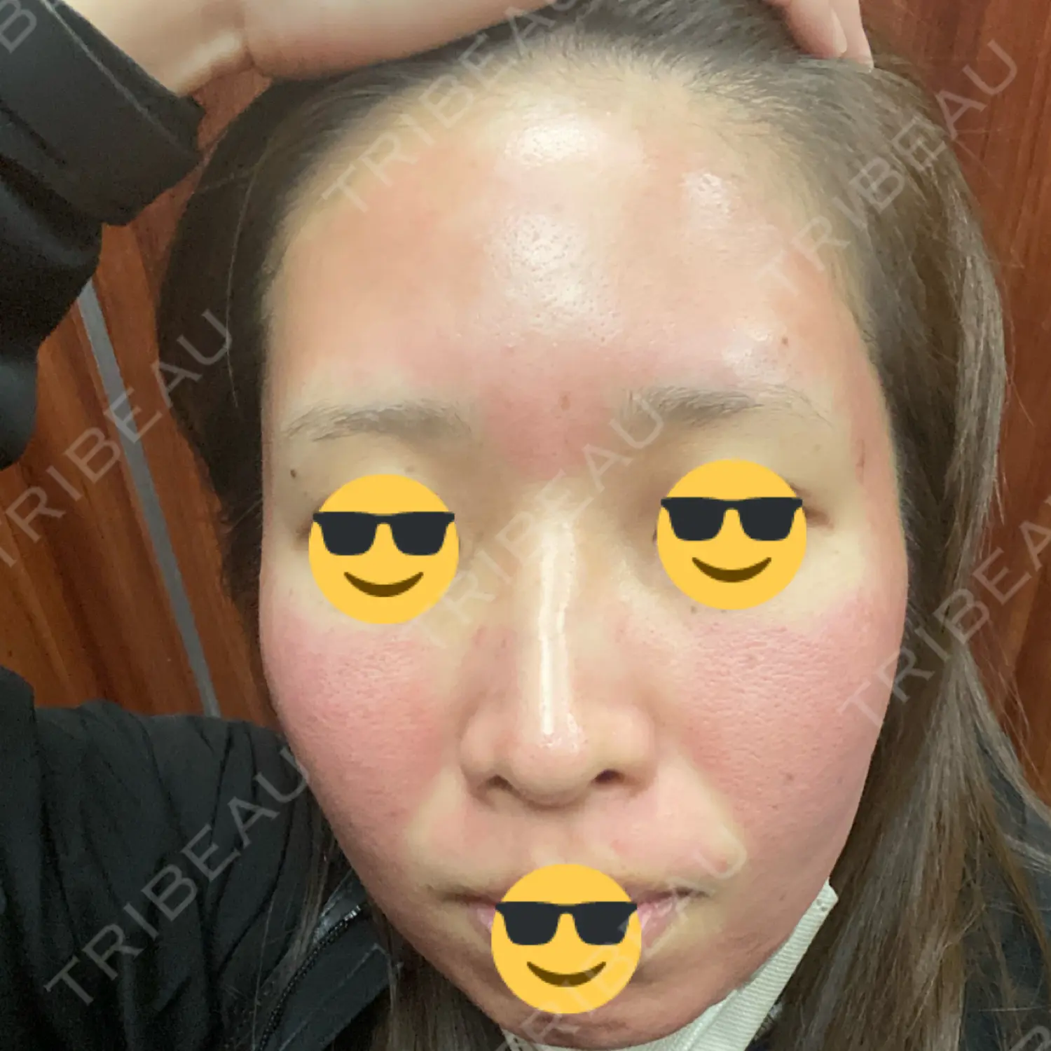 施術後の写真