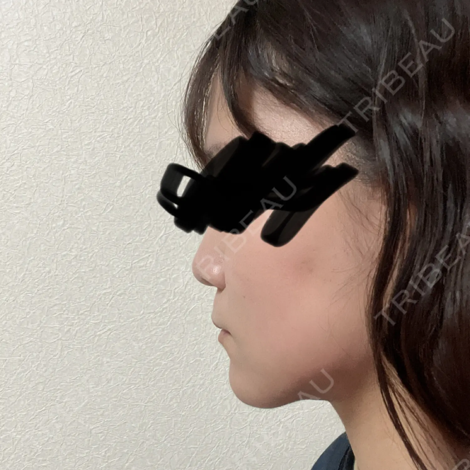施術後の写真