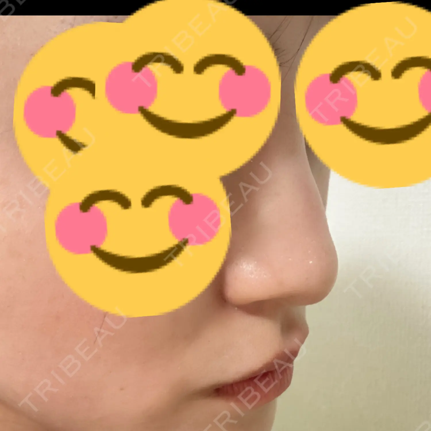 施術後の写真