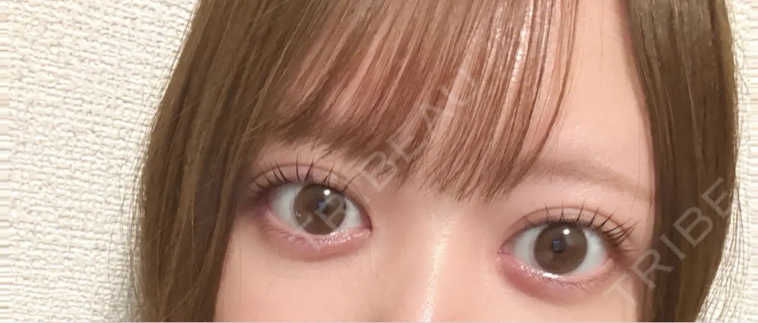 施術後の写真