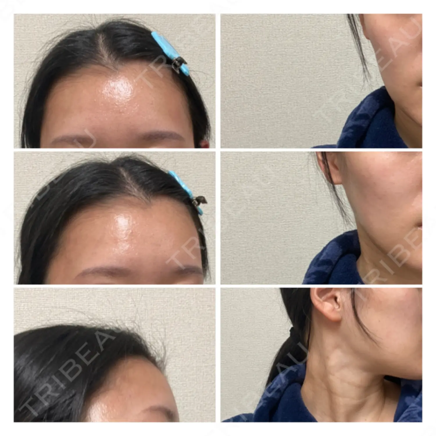 施術後の写真