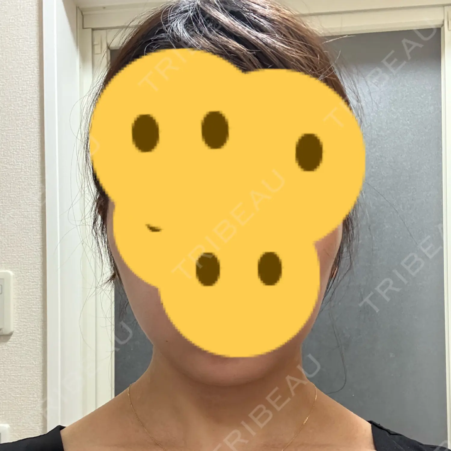 施術後の写真