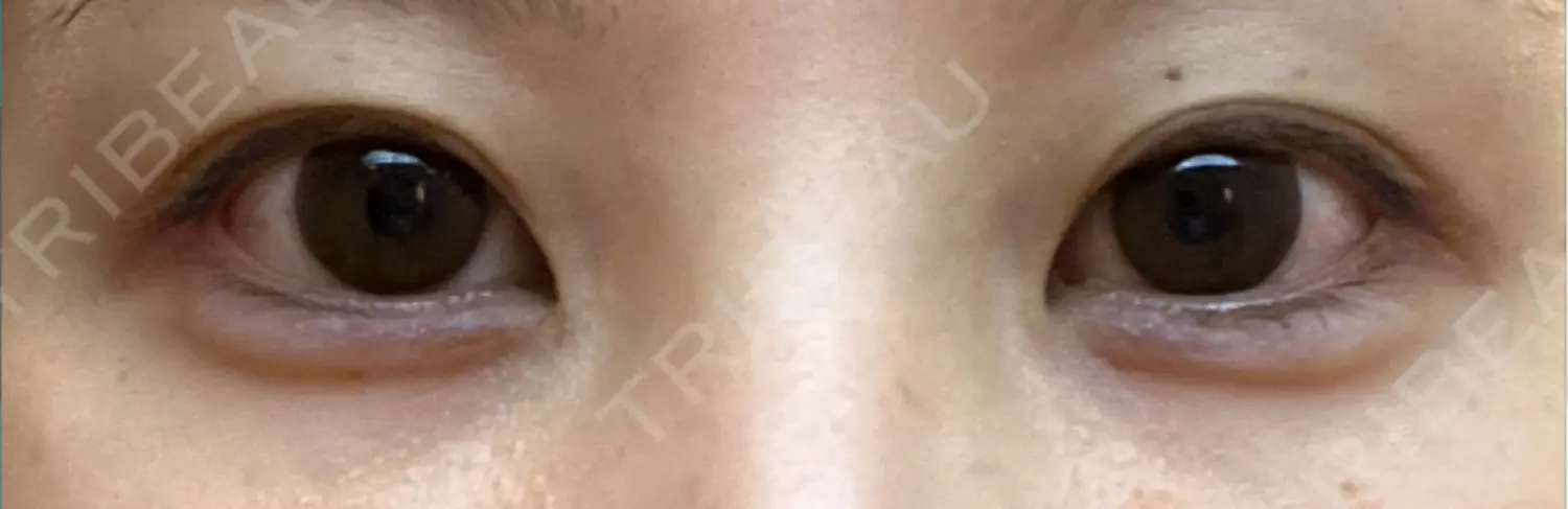 施術後の写真