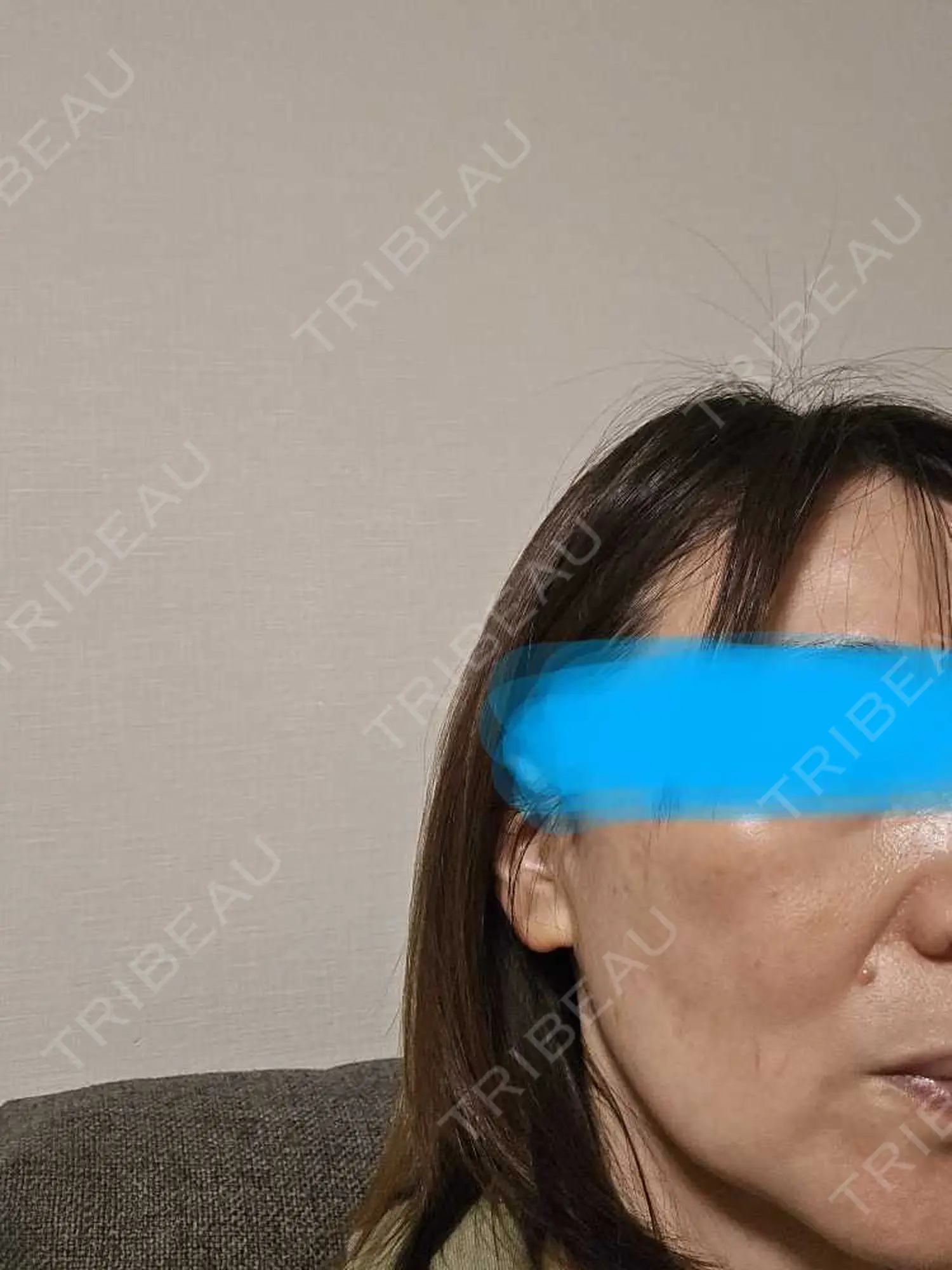 施術後の写真