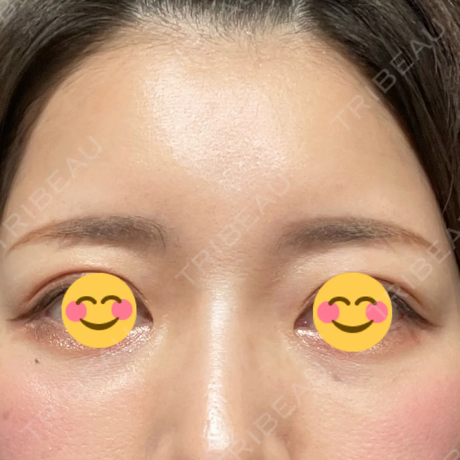 施術後の写真