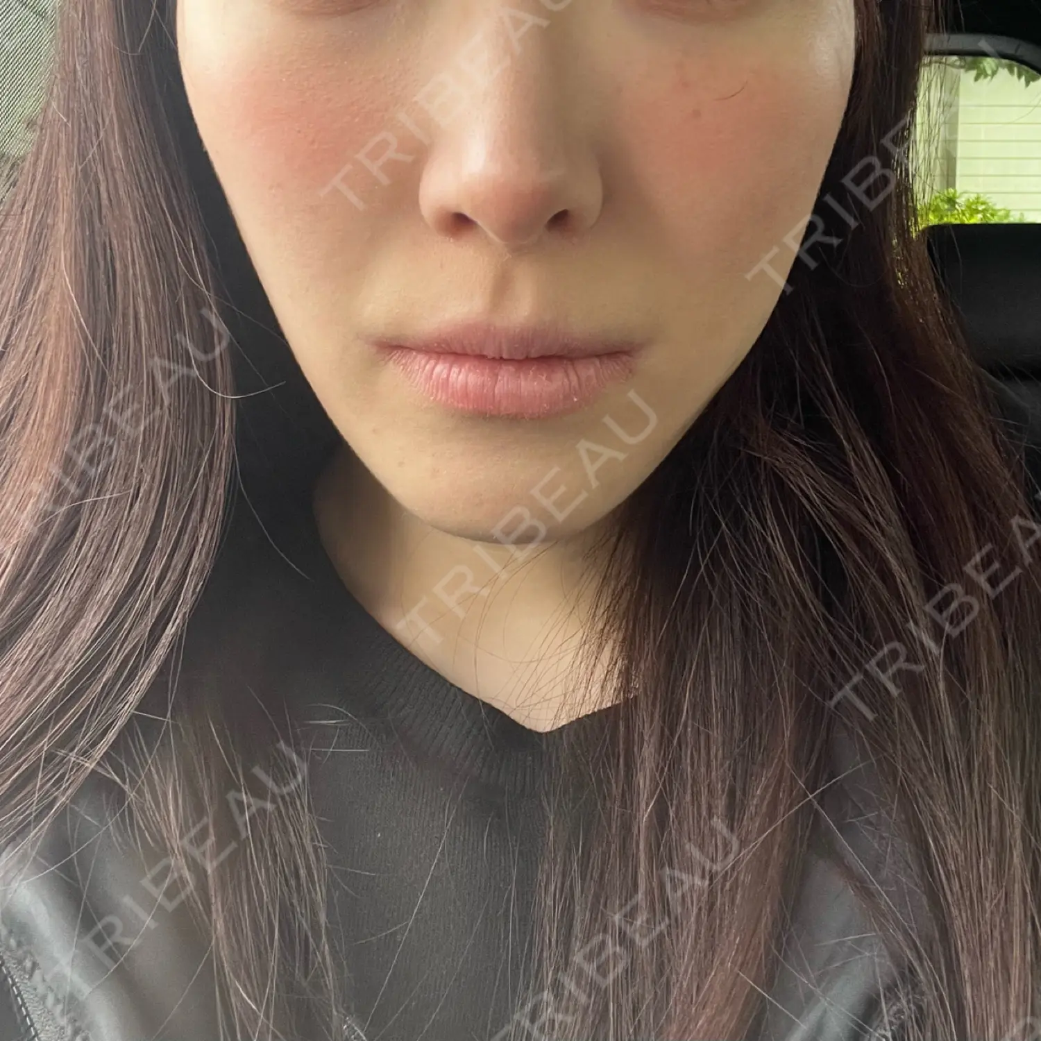 施術後の写真