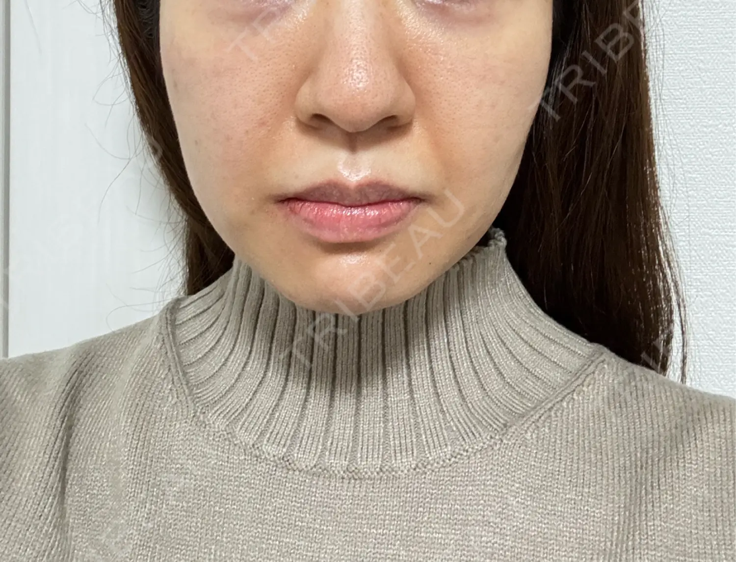 施術後の写真
