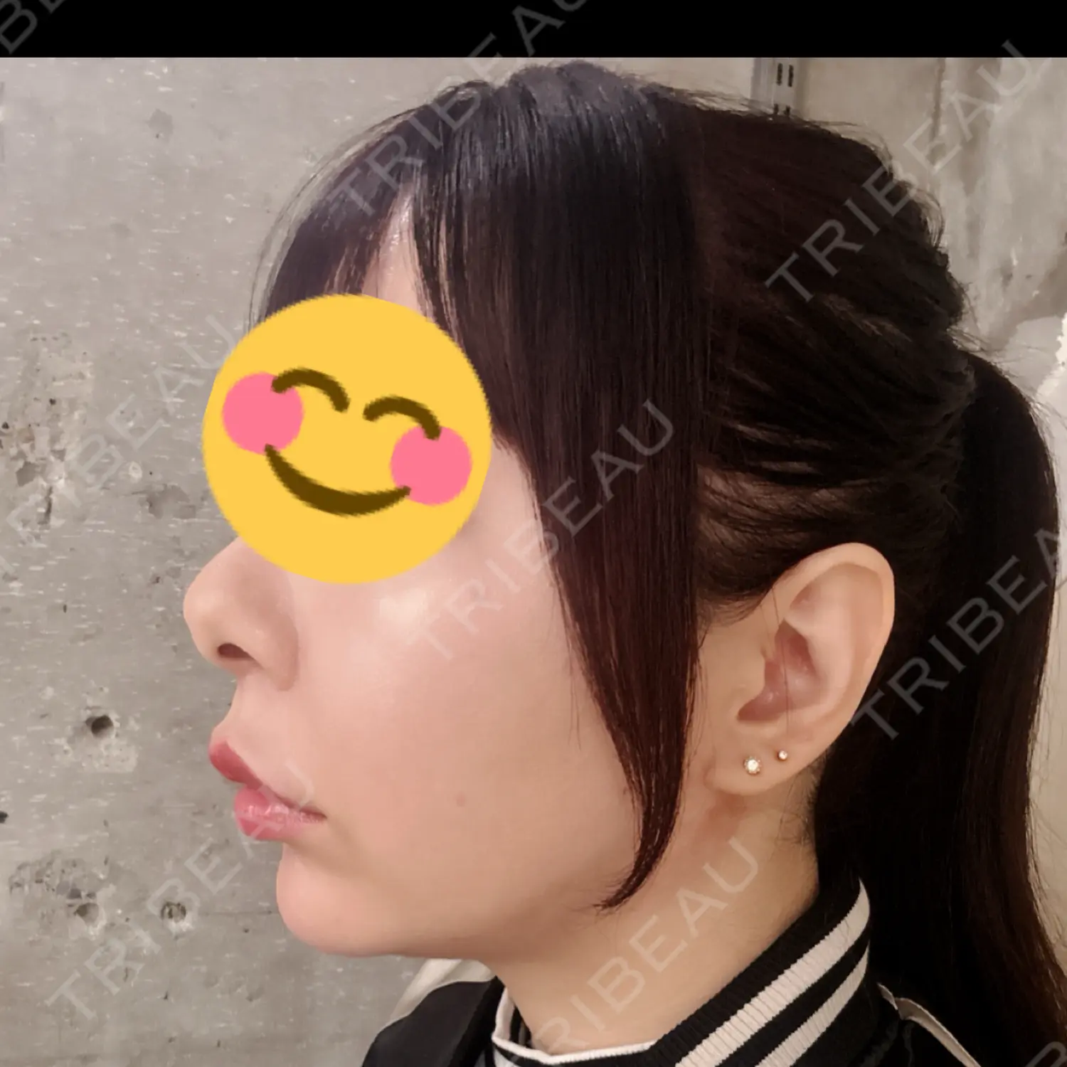 施術後の写真