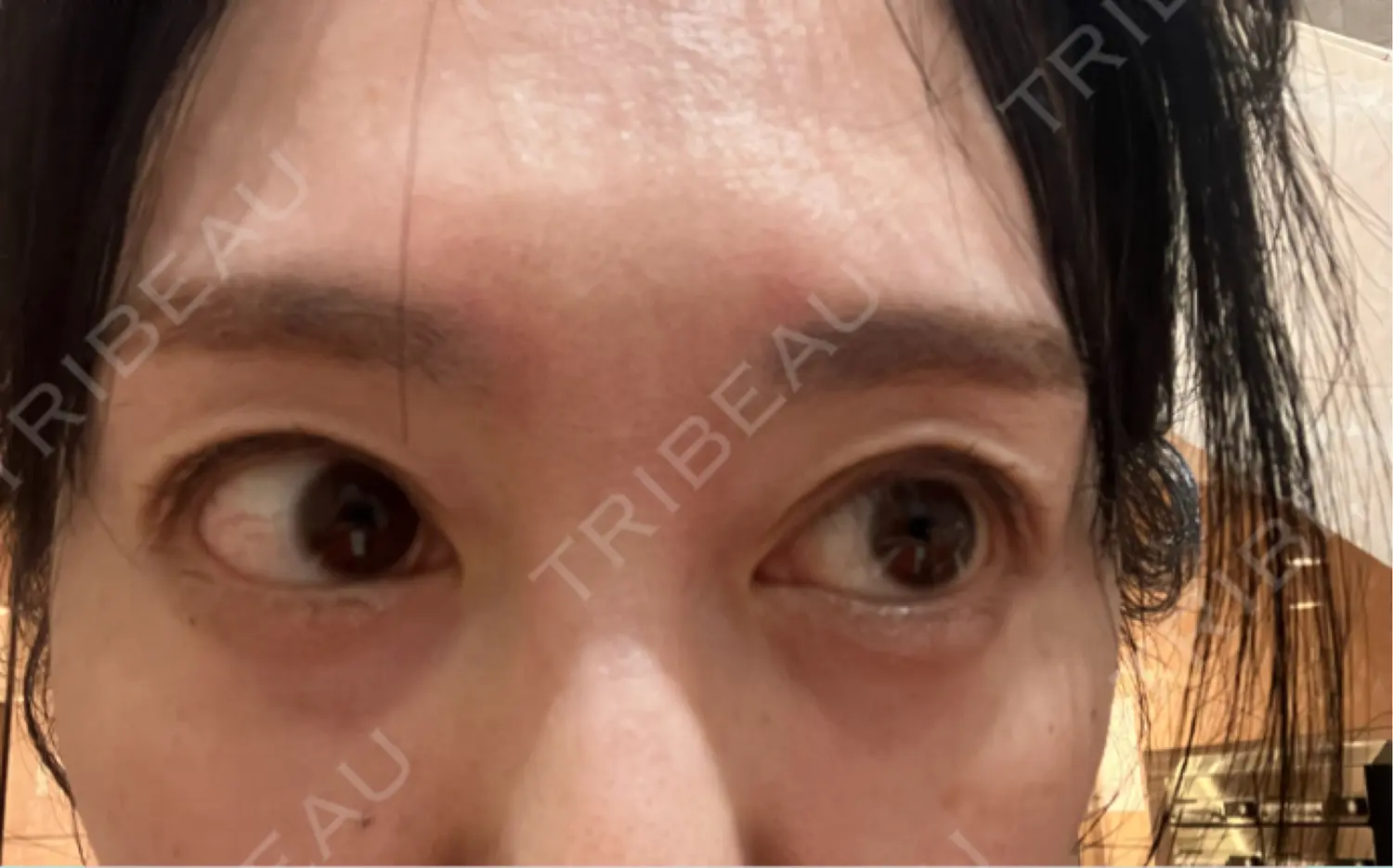 施術後の写真