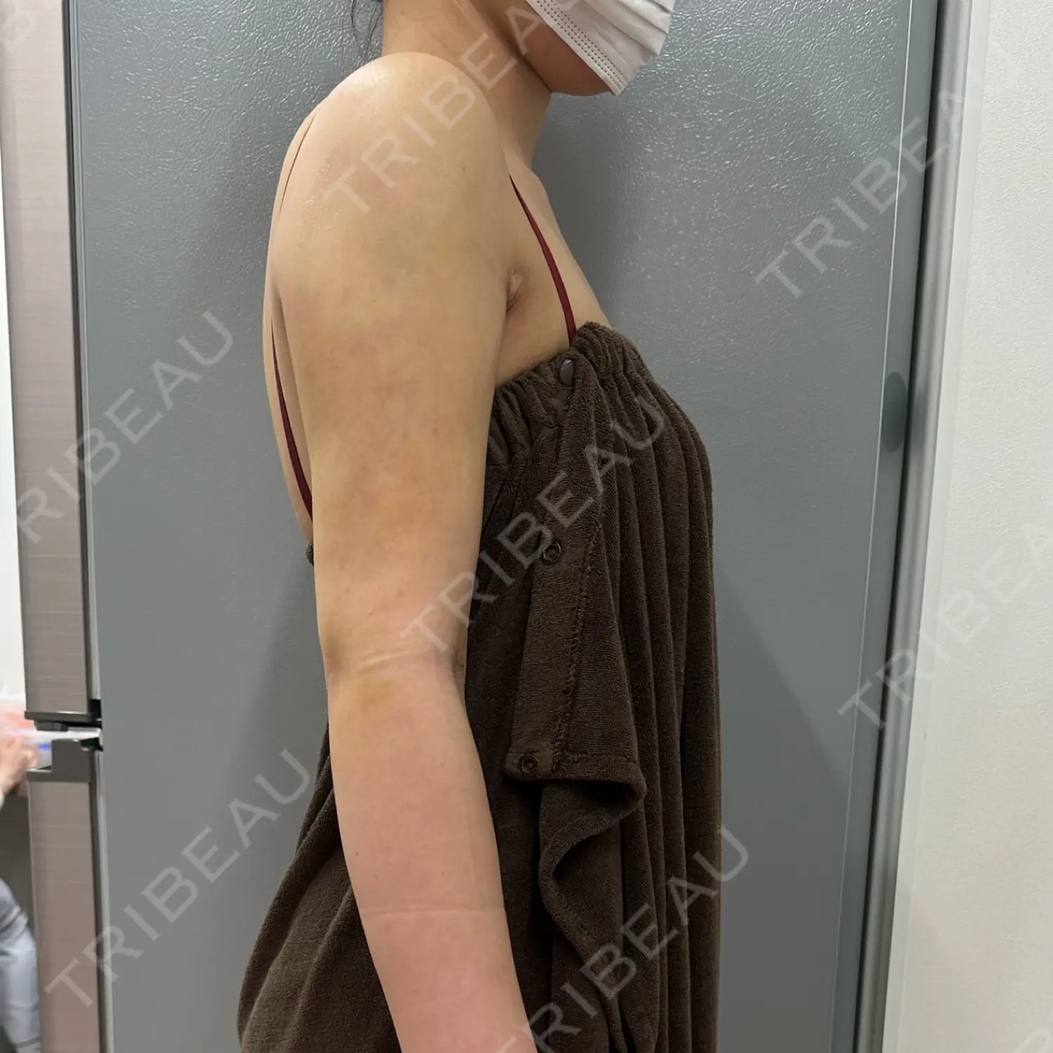 施術後の写真