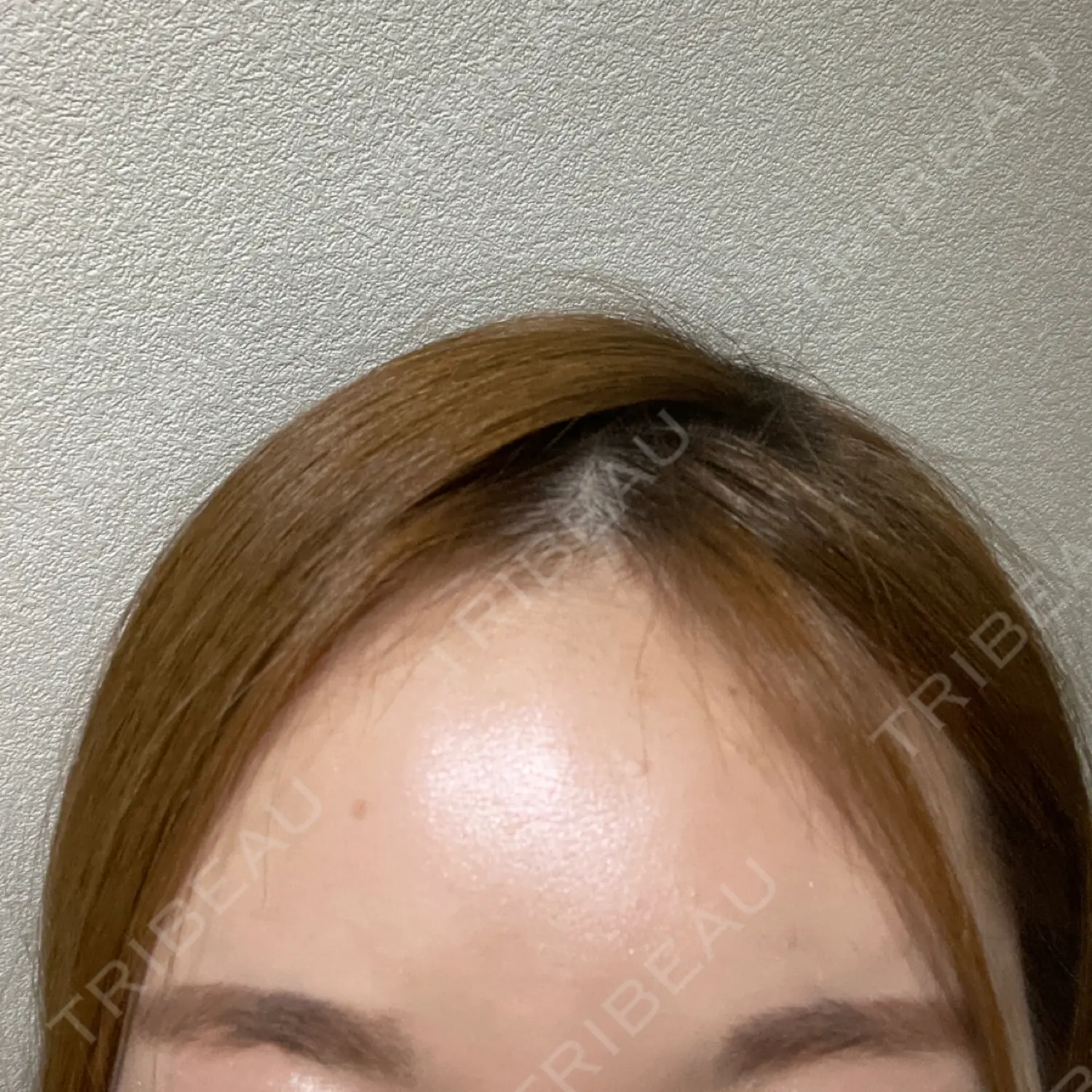 施術後の写真
