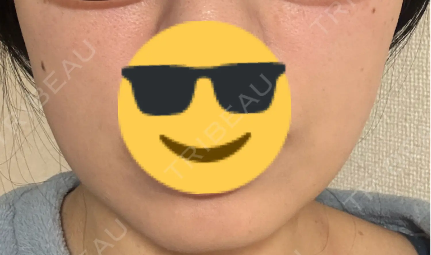 施術後の写真