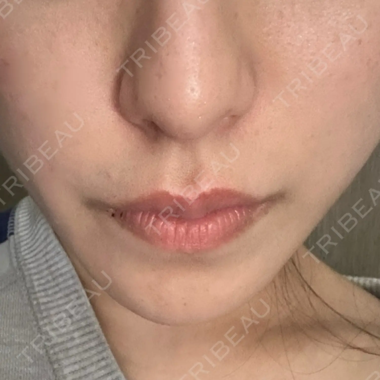 施術後の写真