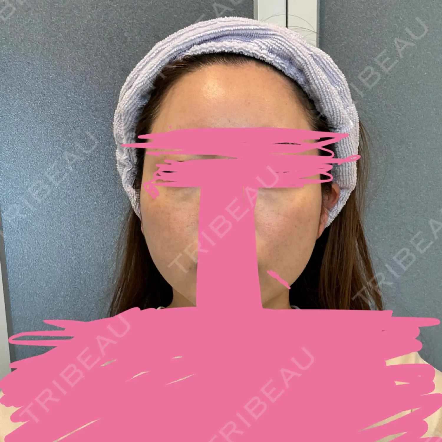 施術後の写真