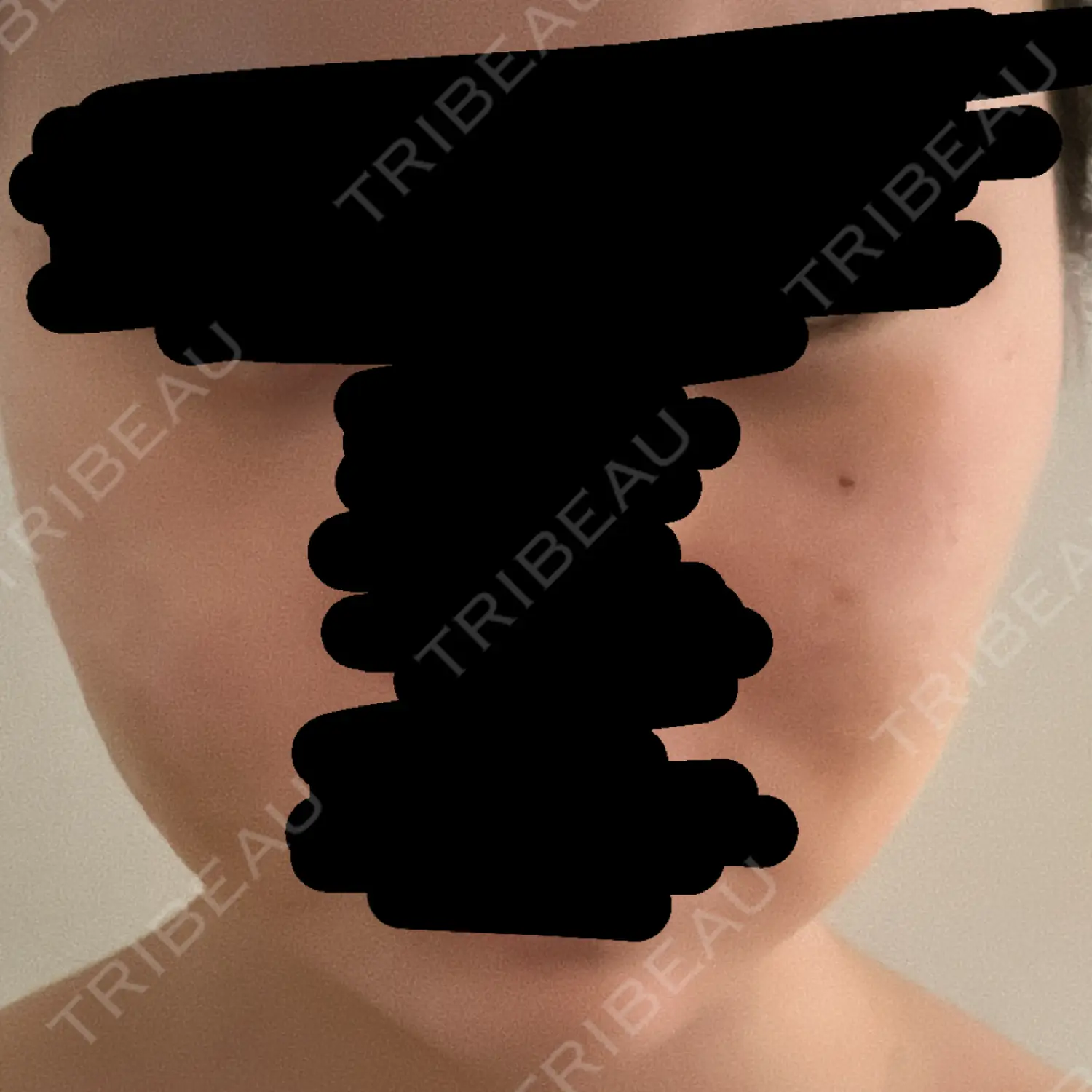 施術後の写真