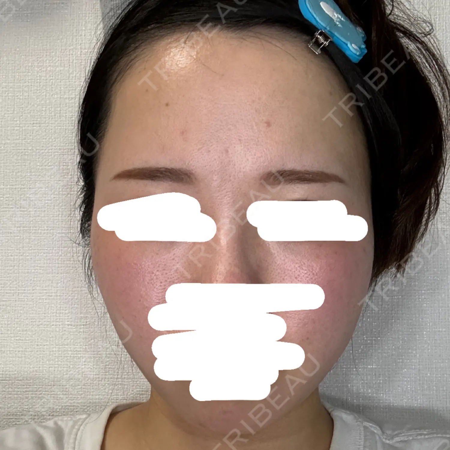 施術後の写真