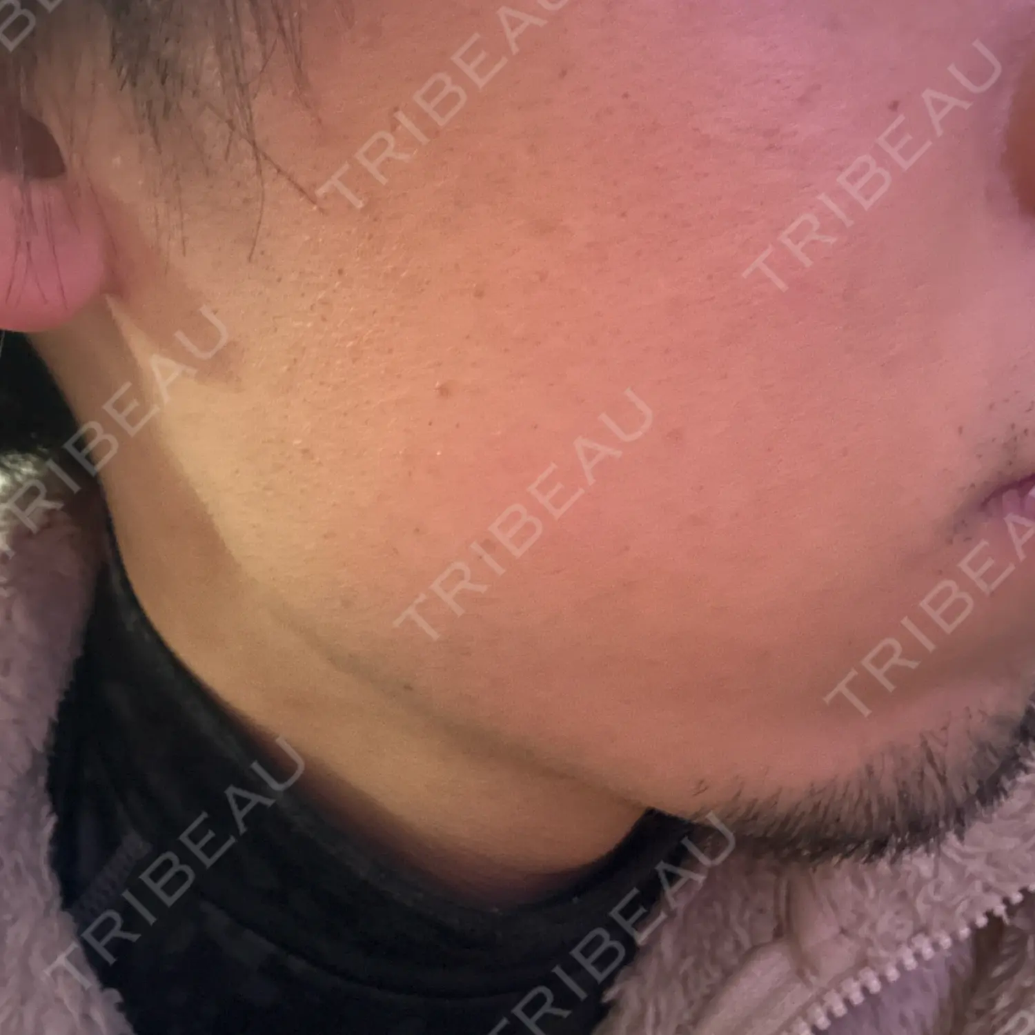 施術後の写真