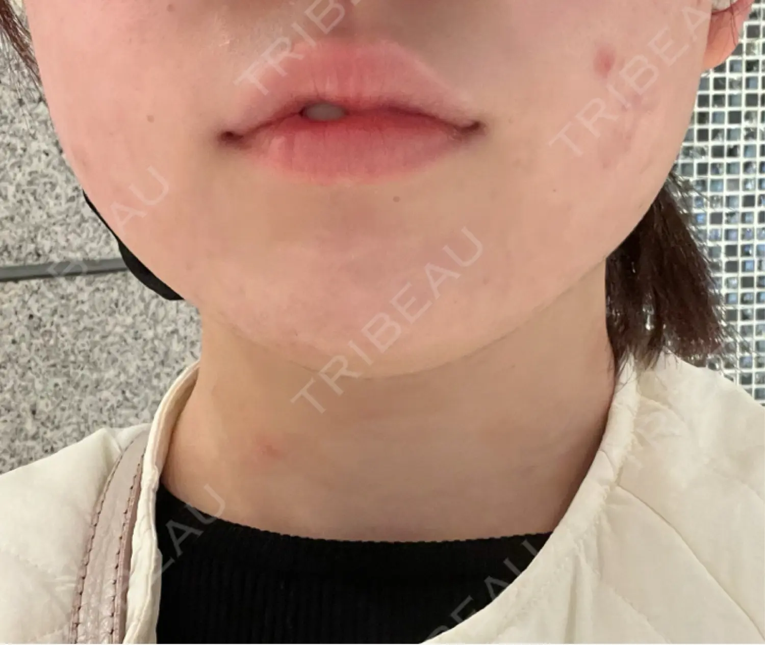 施術後の写真