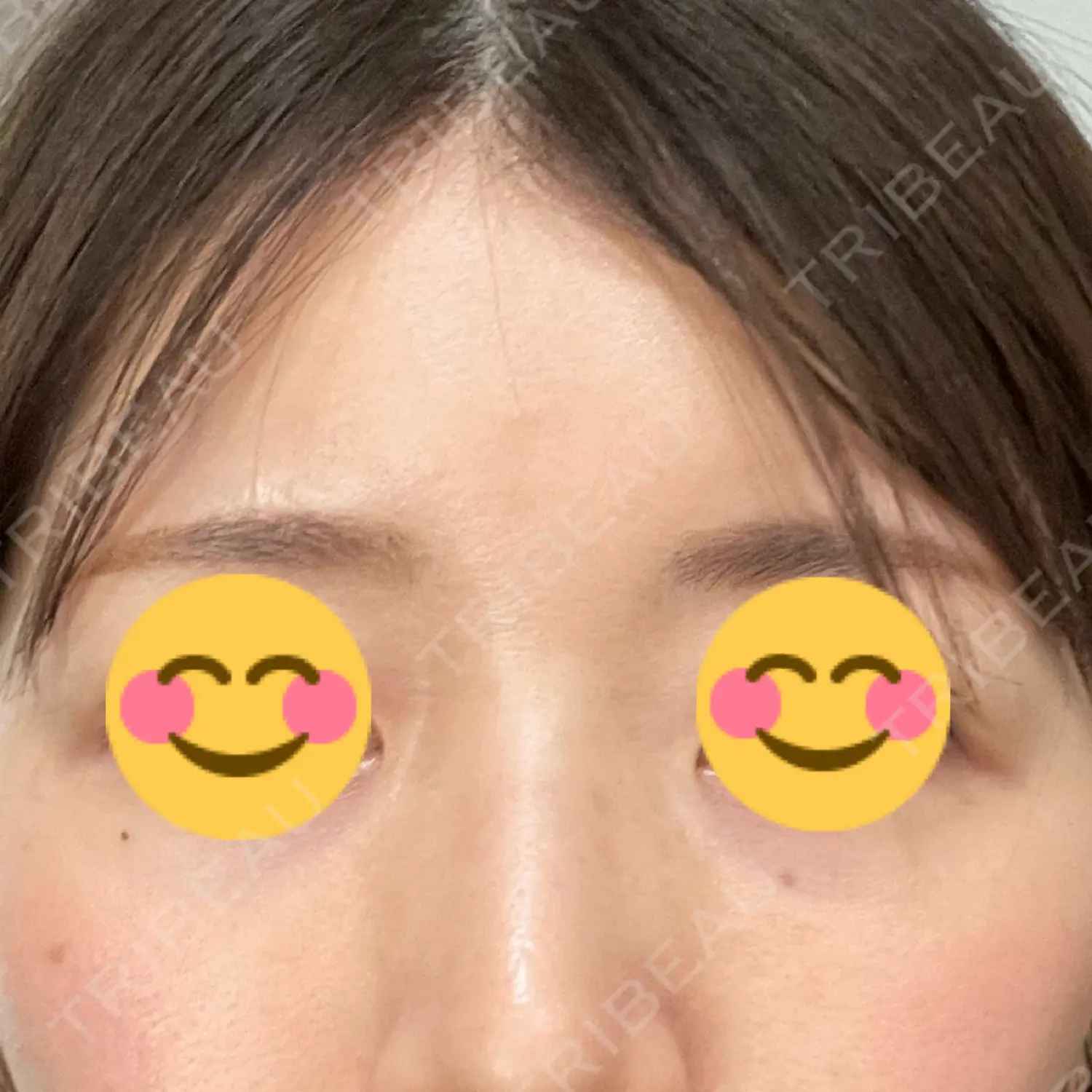 施術後の写真