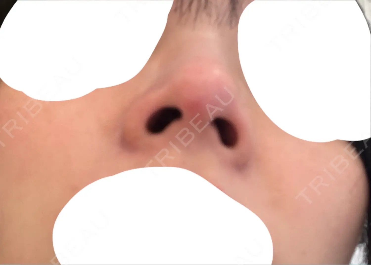 施術後の写真
