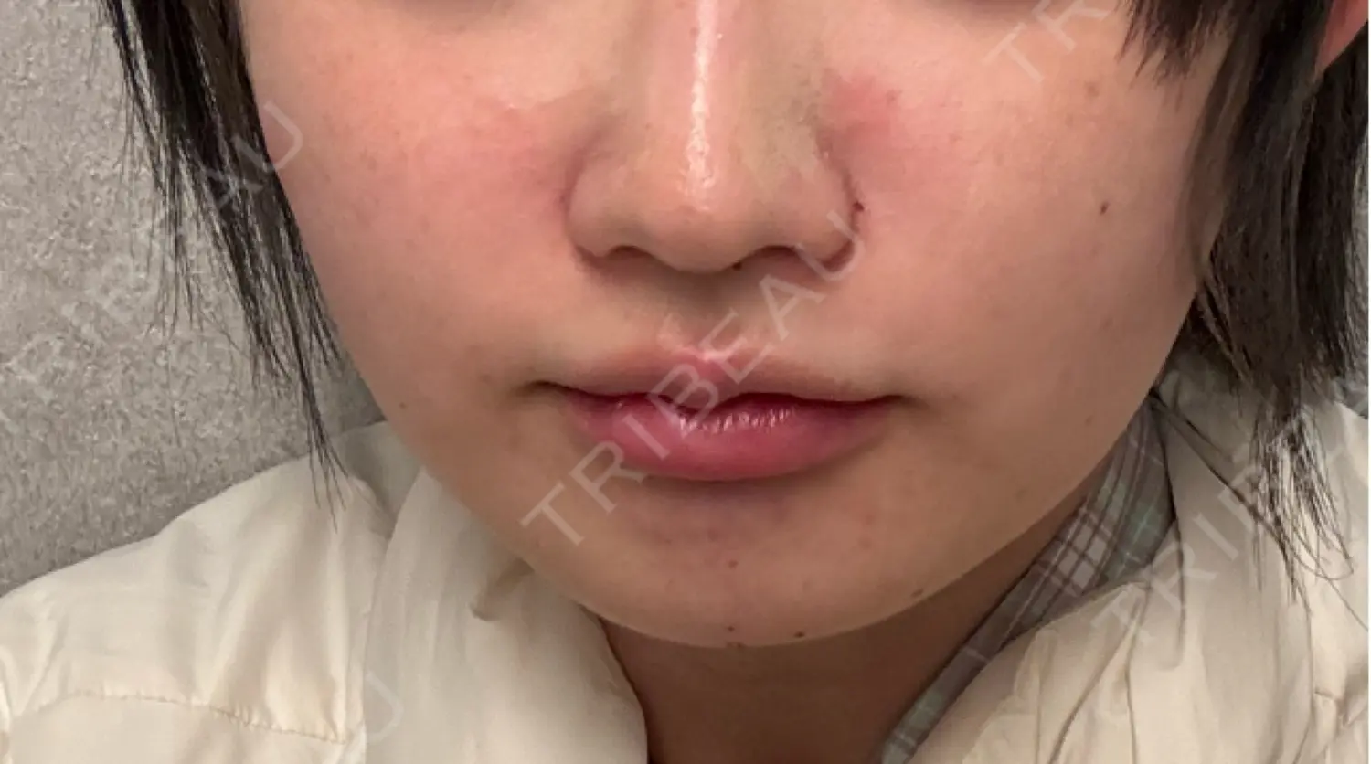 施術後の写真