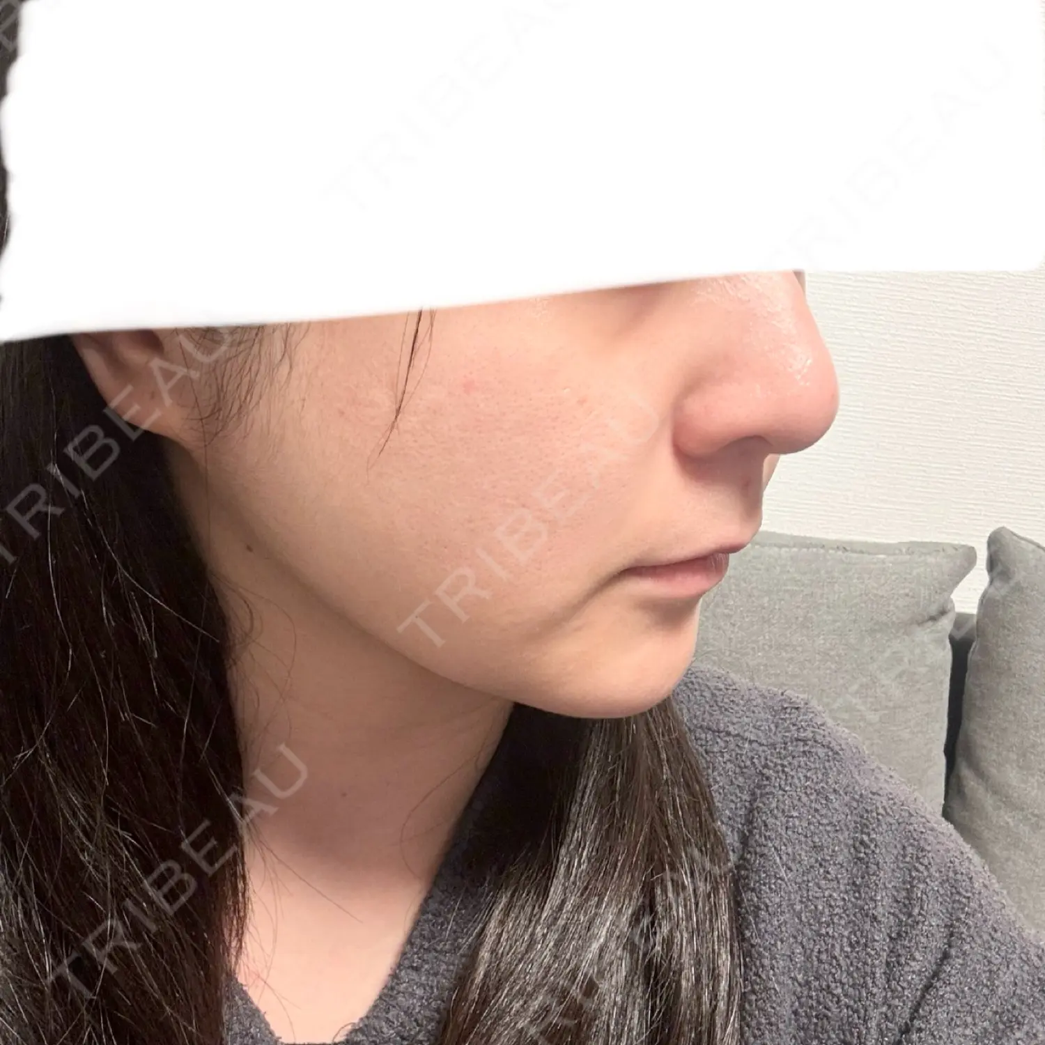 施術後の写真