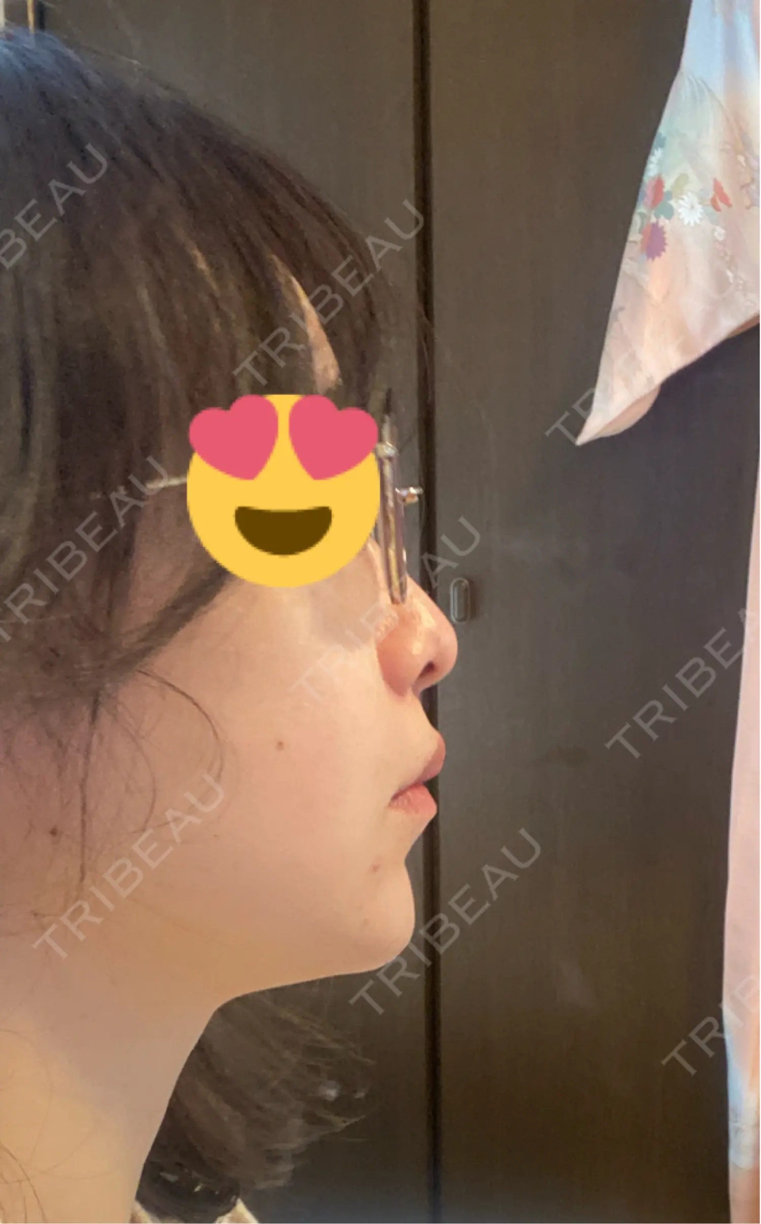 施術後の写真