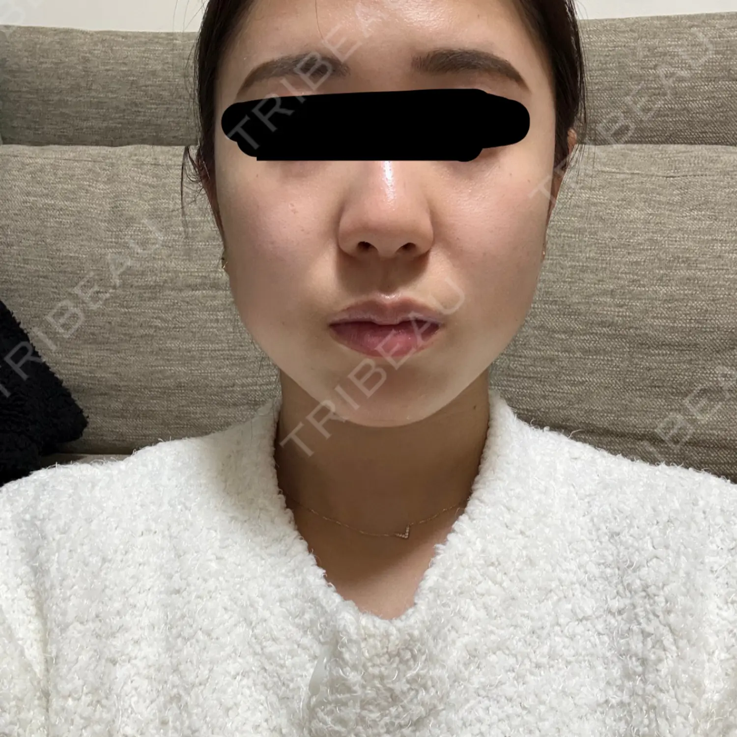 施術後の写真
