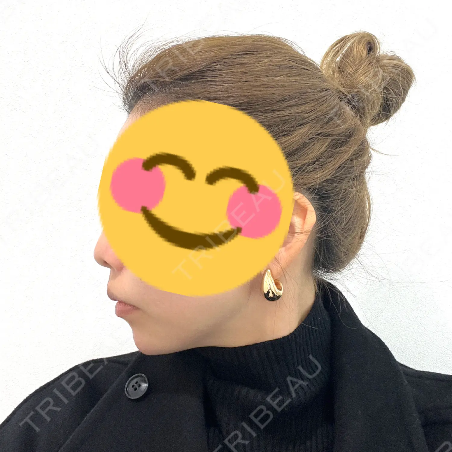 施術後の写真