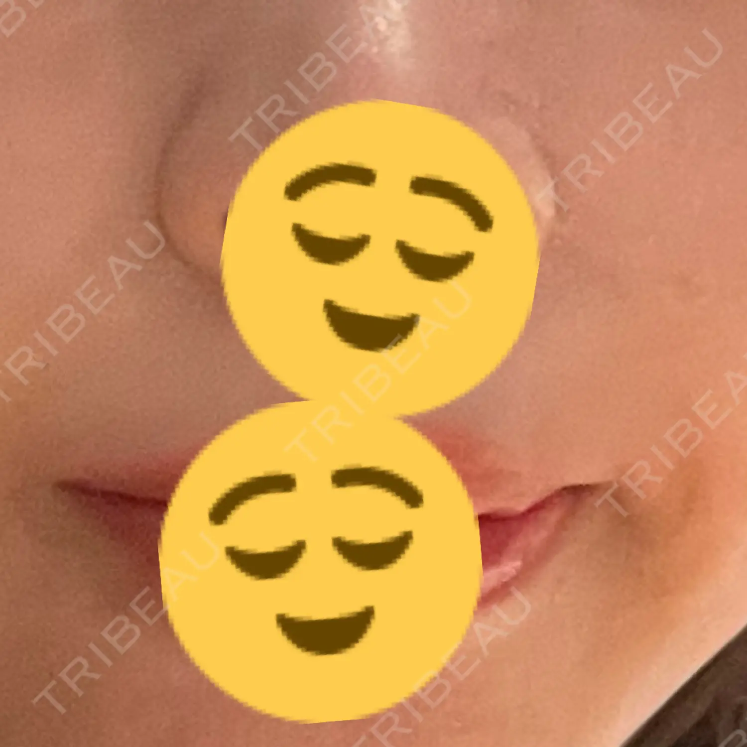 施術後の写真