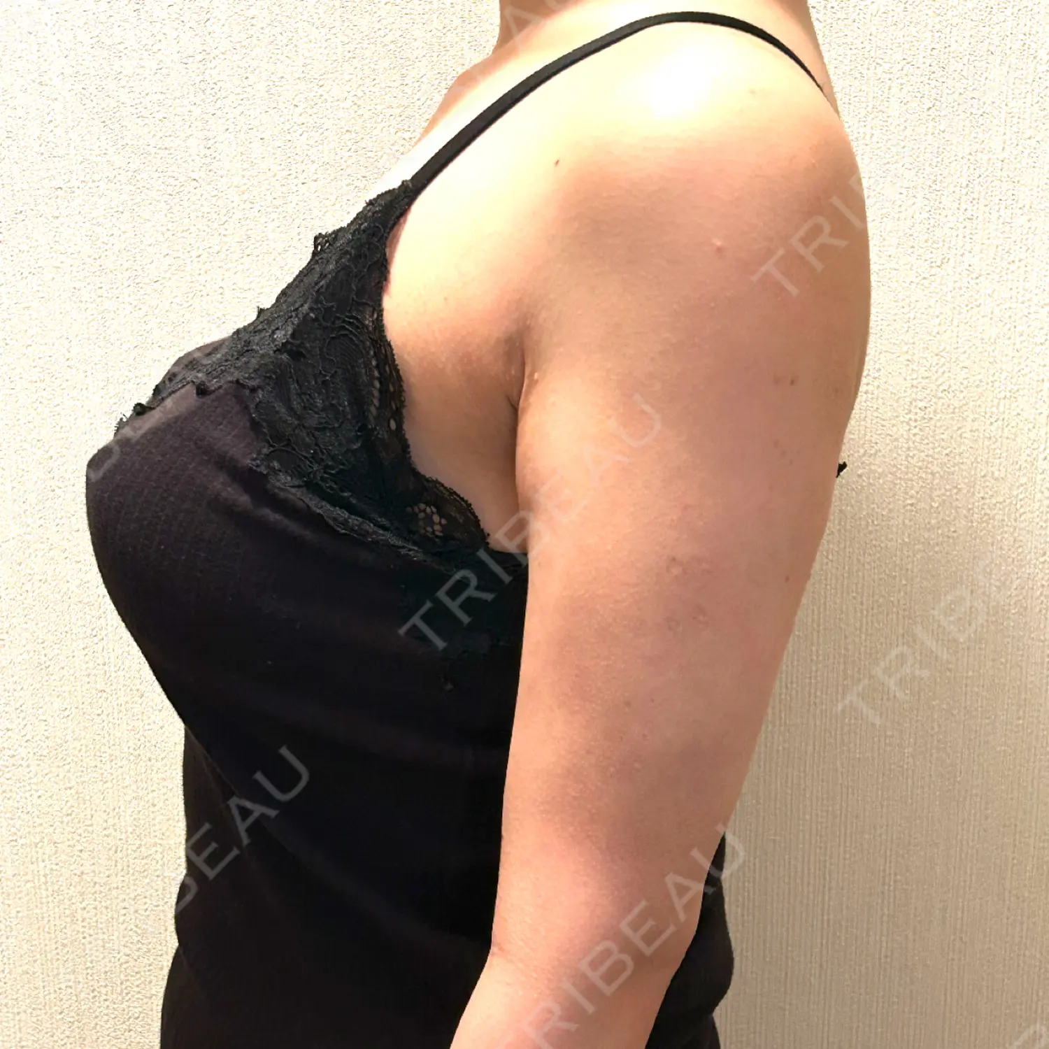 施術後の写真