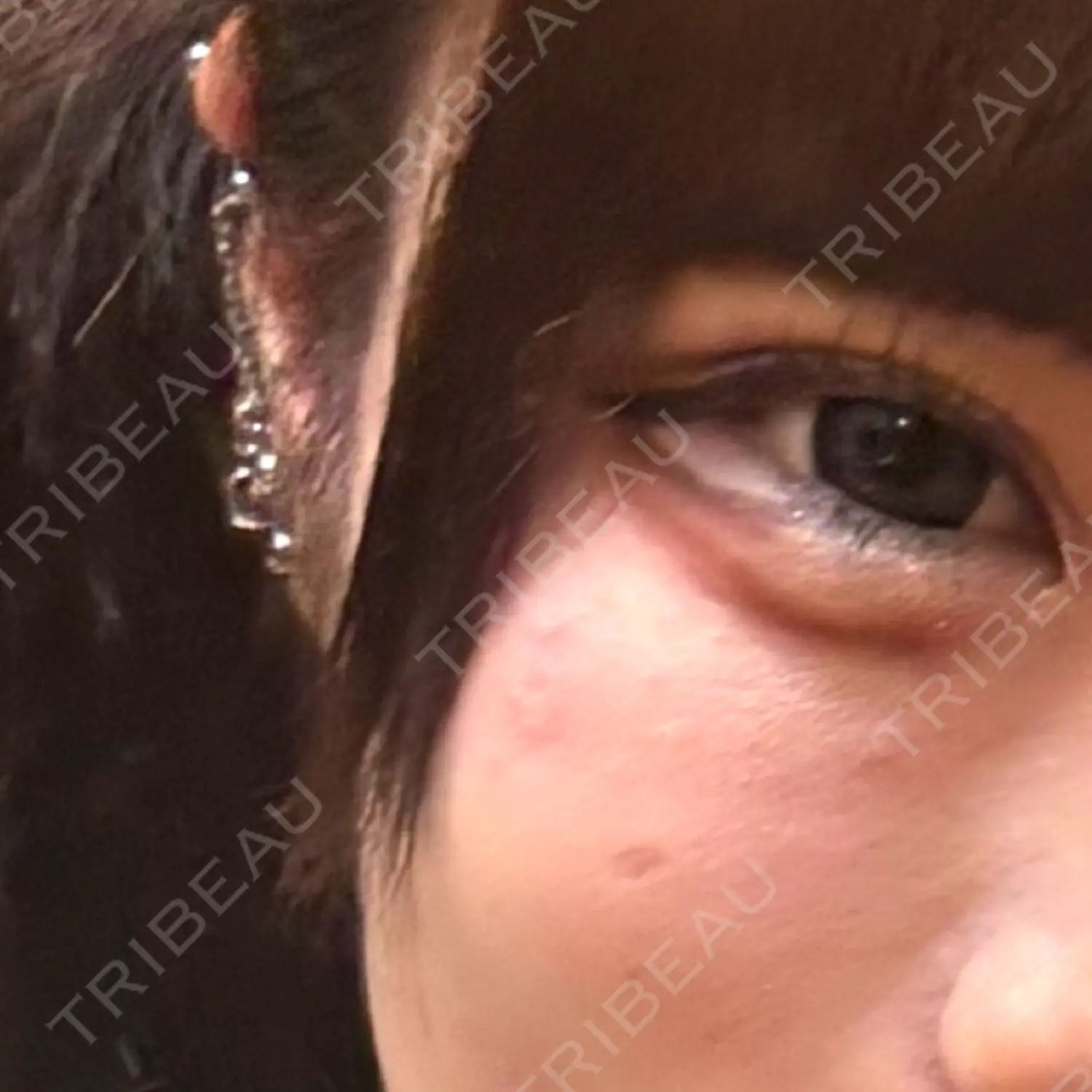 施術後の写真