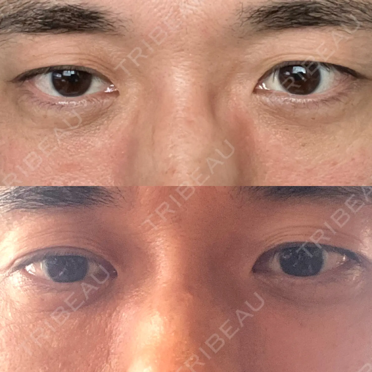 施術後の写真