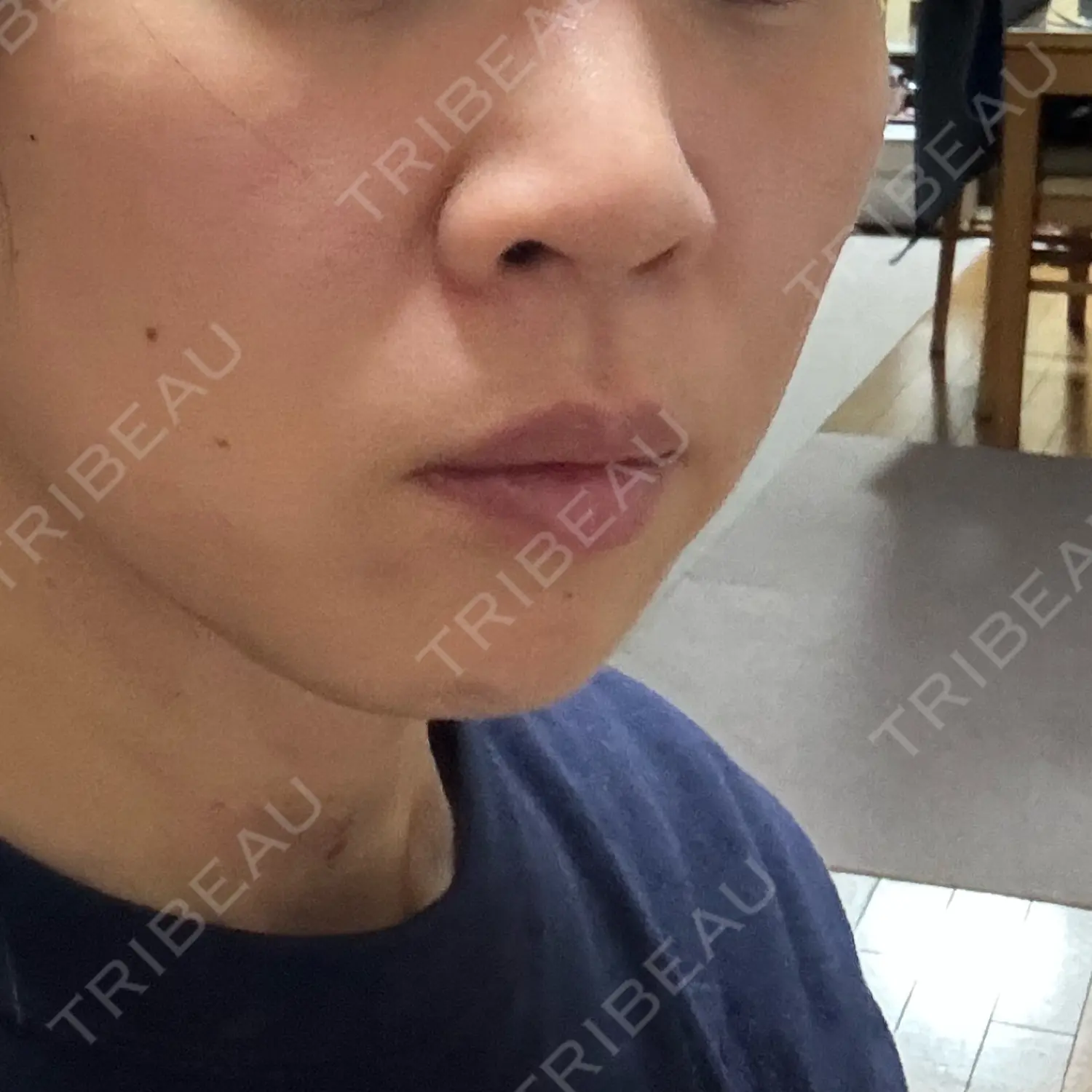 施術後の写真