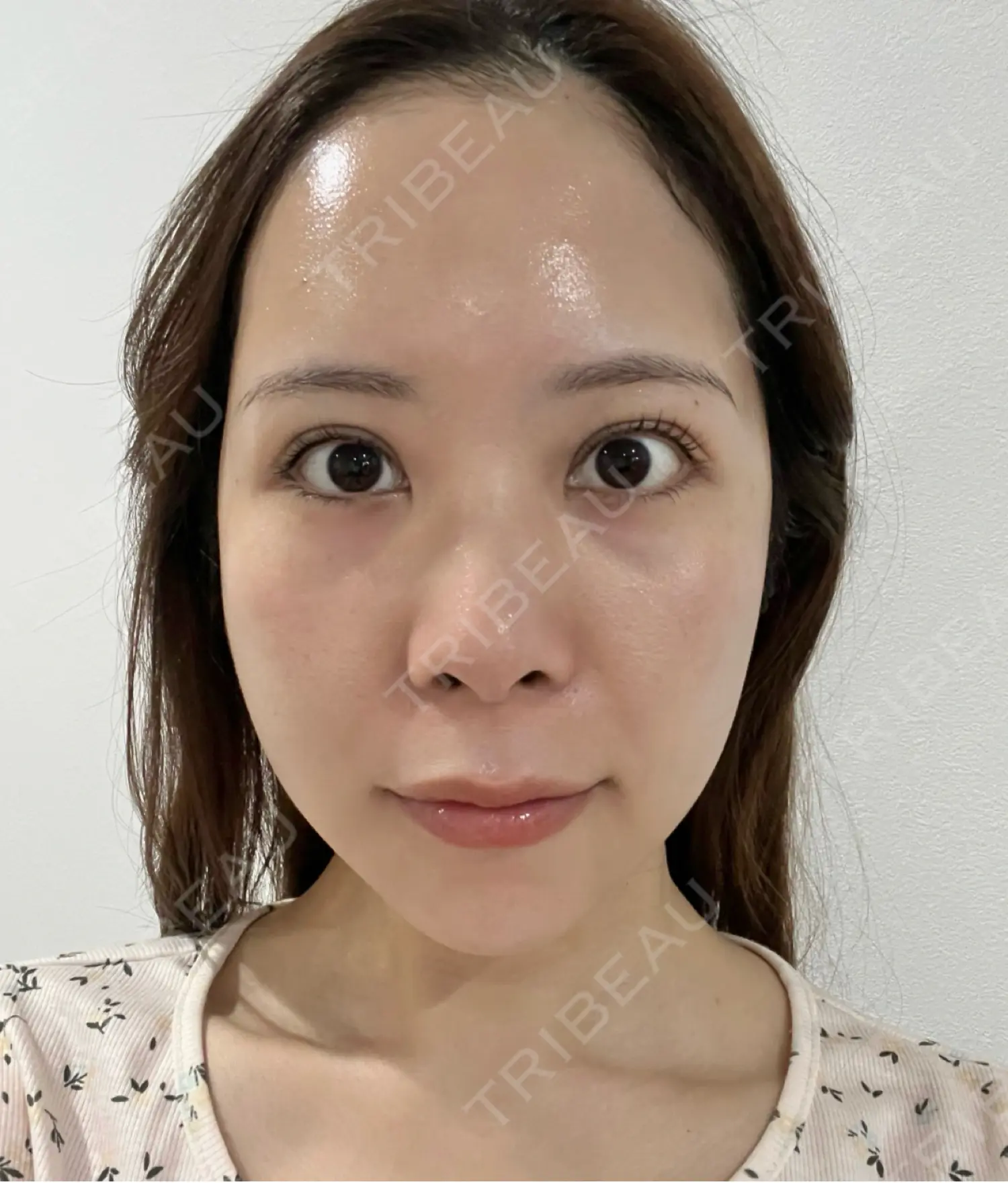 施術後の写真