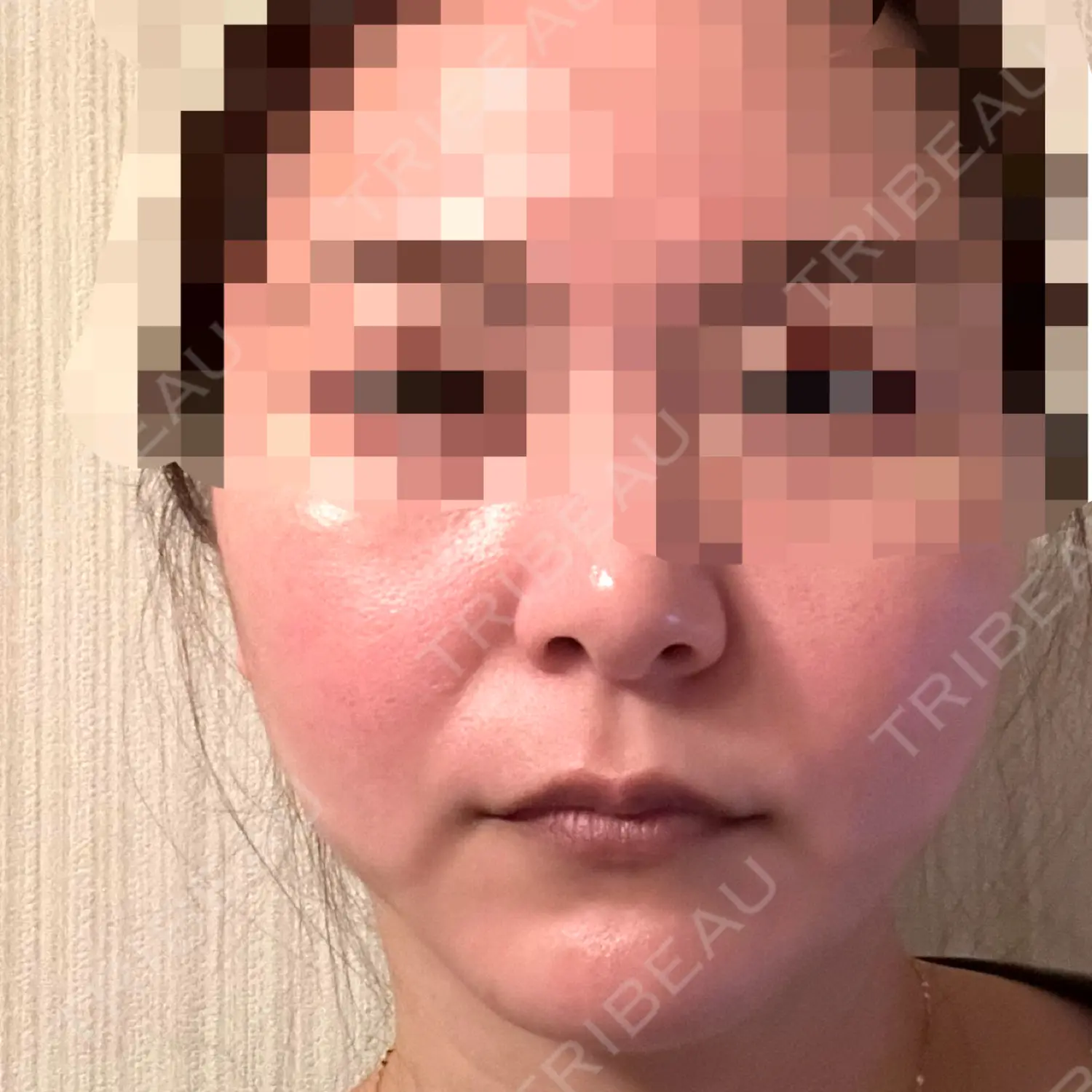 施術後の写真