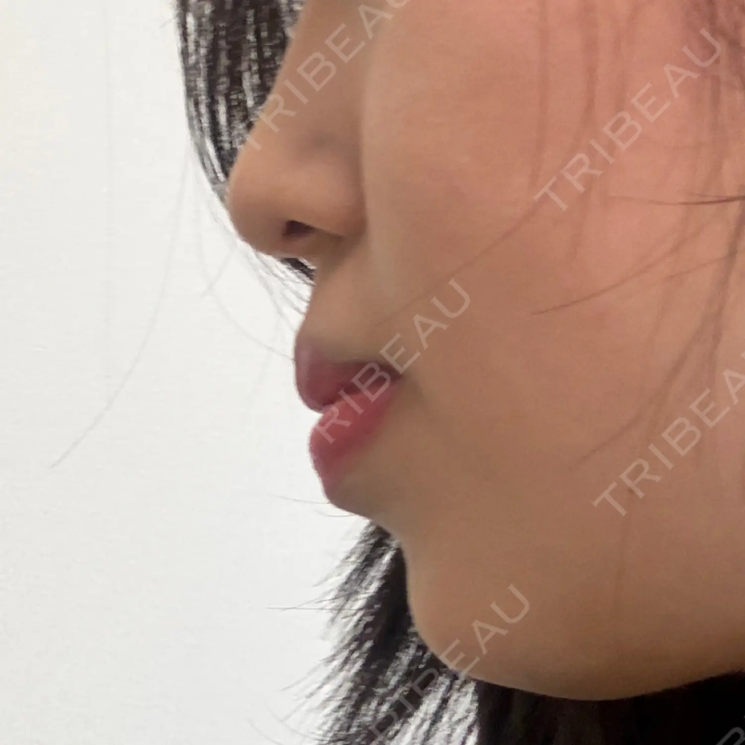 施術後の写真