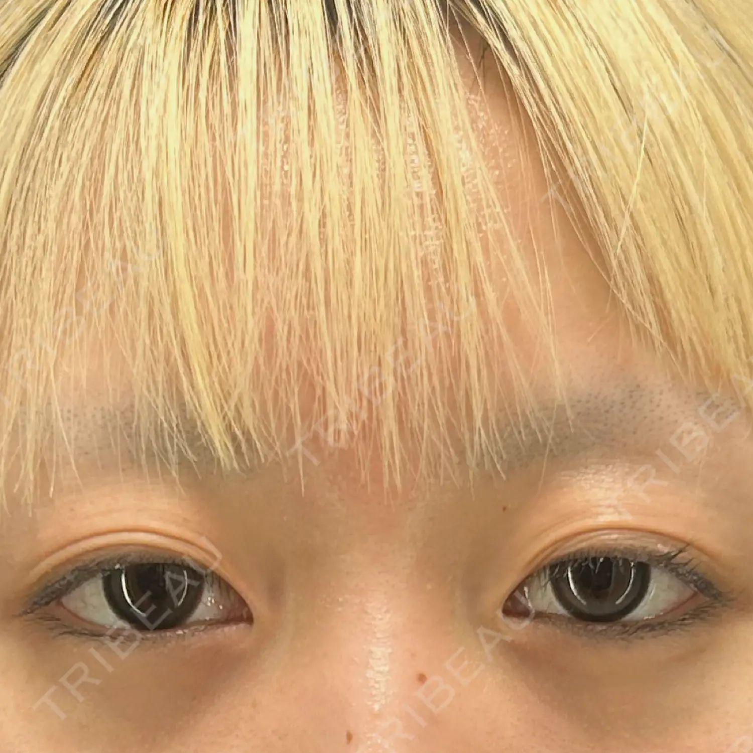 施術後の写真
