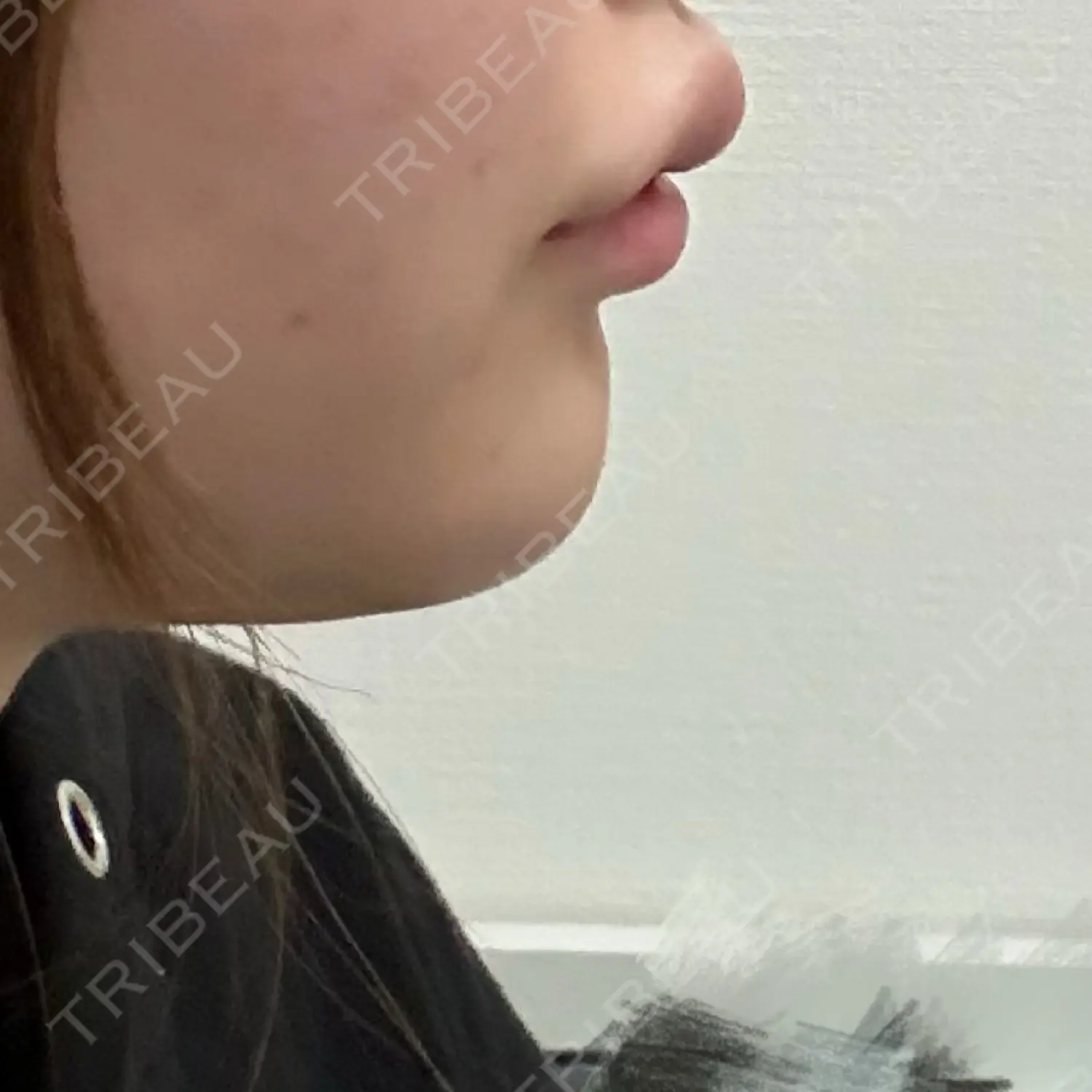 施術後の写真