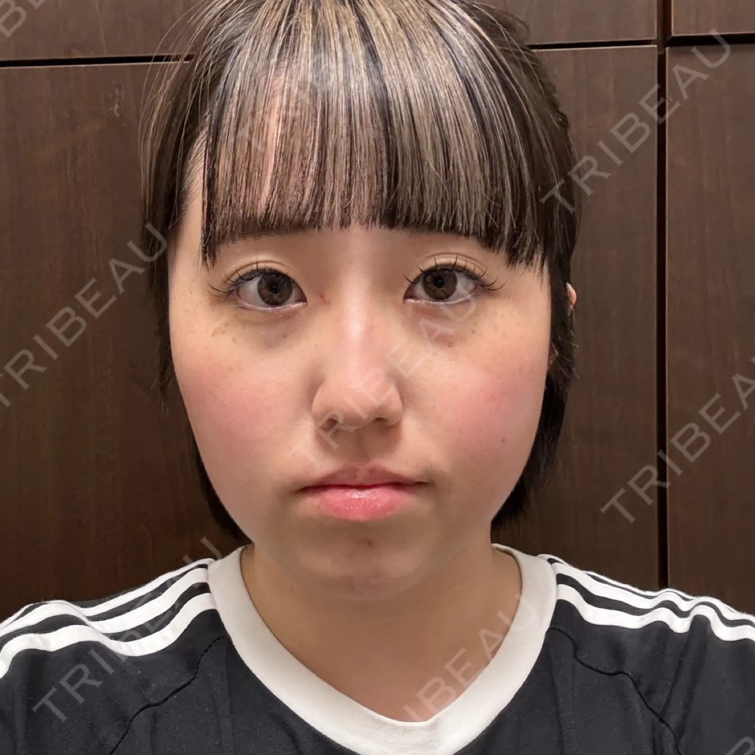 施術後の写真