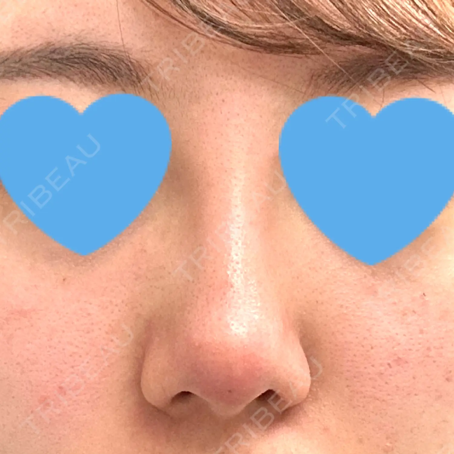 施術後の写真