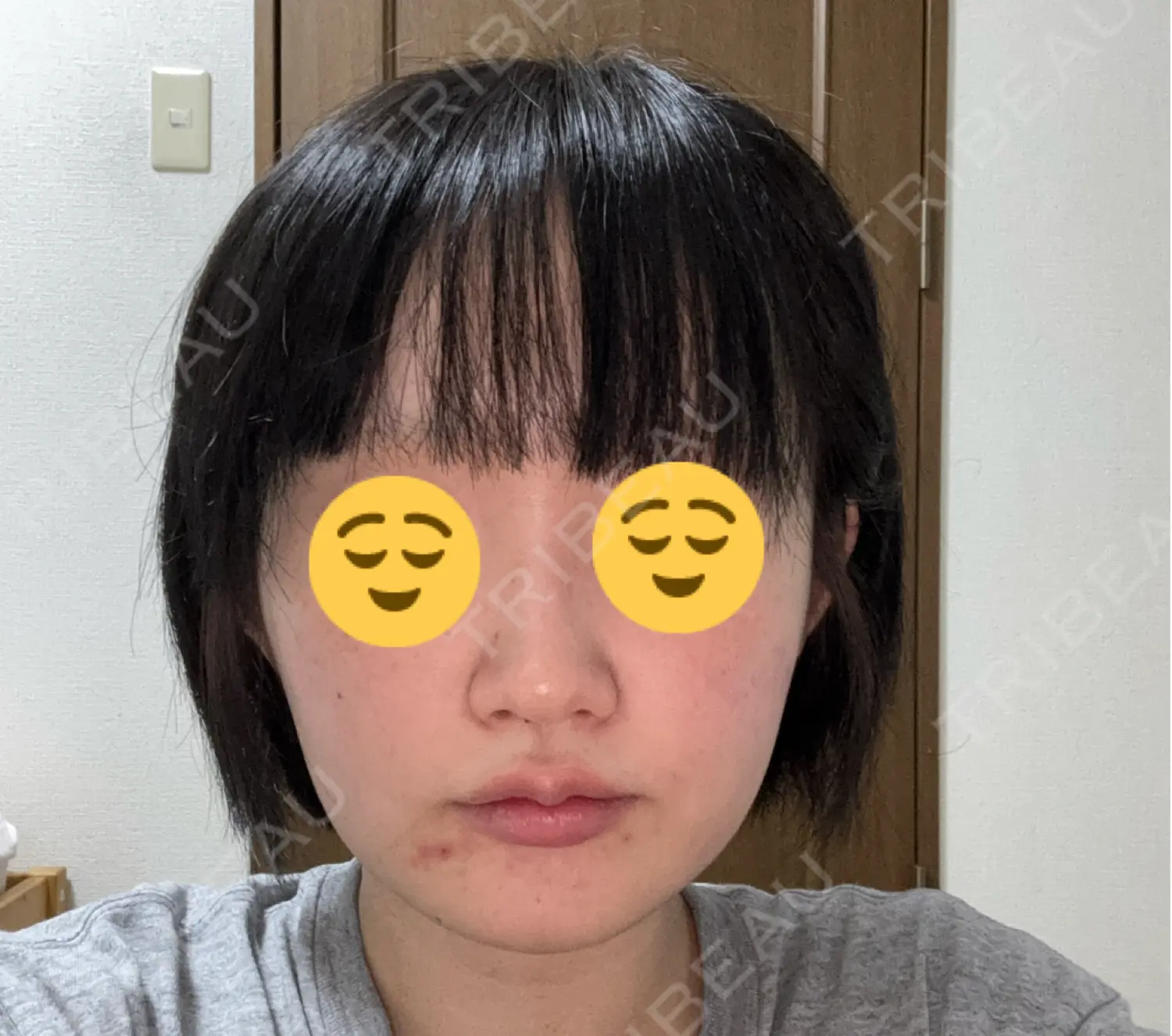 施術後の写真