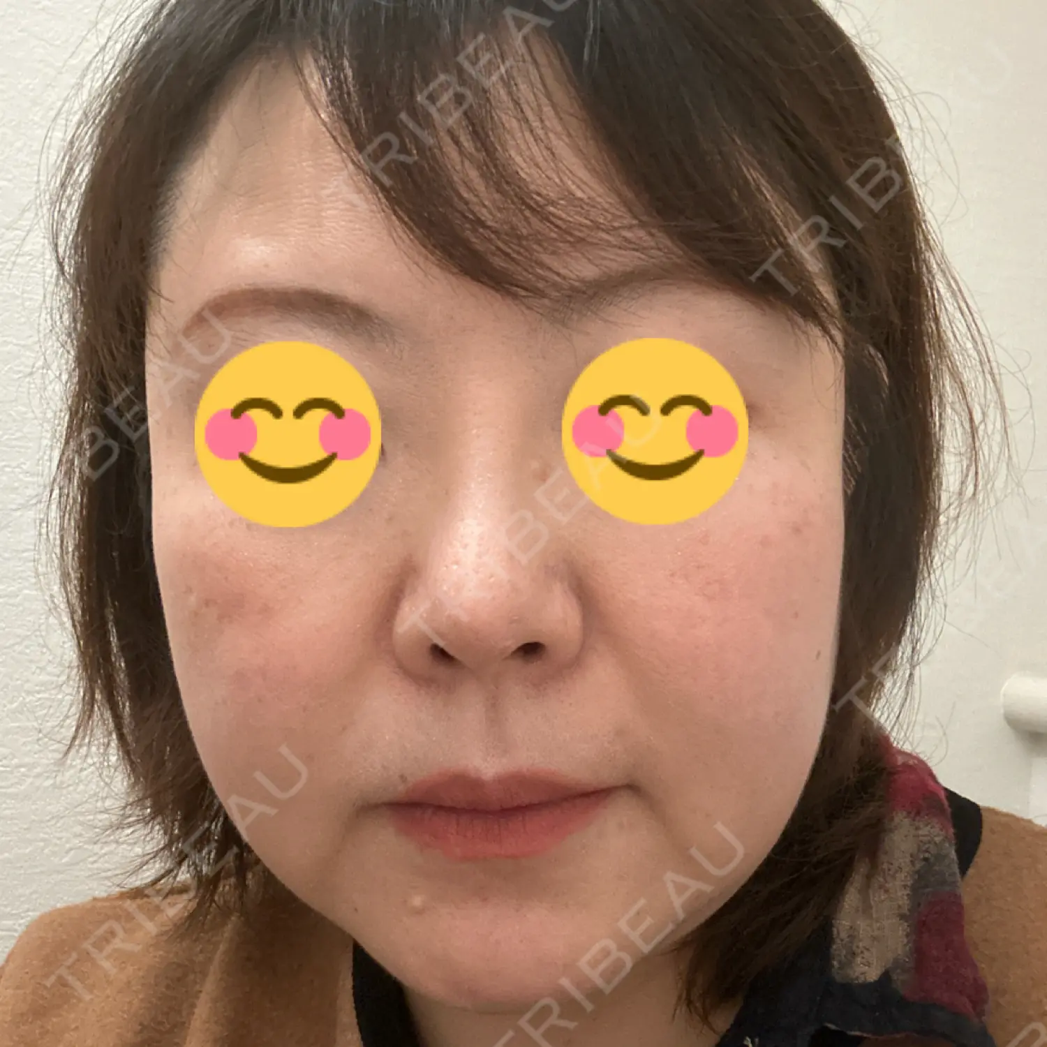 施術後の写真