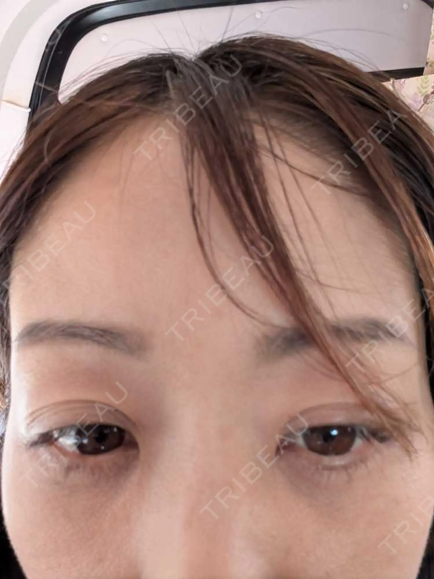 施術後の写真